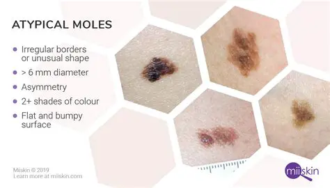 A new mole or change in an existing mole