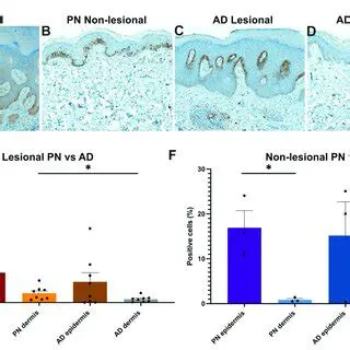 Analysis of Nerve Growth Factor Levels in Serum Psoriasis Vulgaris