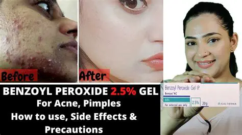 Effect of Benzoyl Peroxide on Adhesive Characteristics