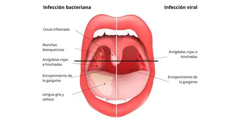 Enrojecimiento de la garganta