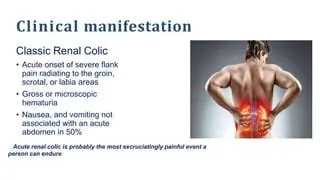 Flank pain radiating to the groin