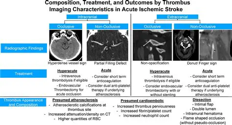 General Profile of Ischemic Stroke Patients