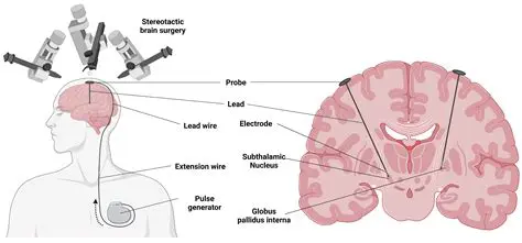 How the Abyssal Brain Stimulator Works