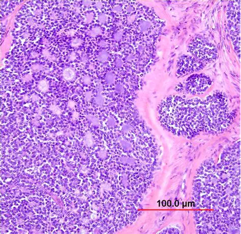 Invasive Cervical Carcinoma