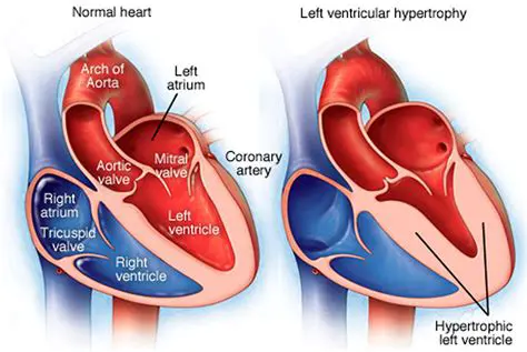 Left Ventricular Hypertrophy