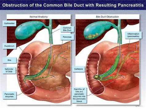 Pancreatic duct obstruction