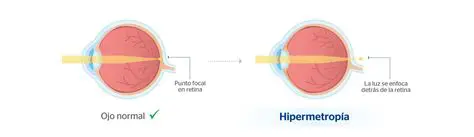 Preguntas y Respuestas sobre la Hipermetropia