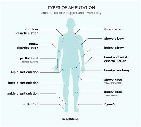 Preserve the amputated body part