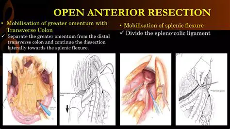 Resection with anastomosis