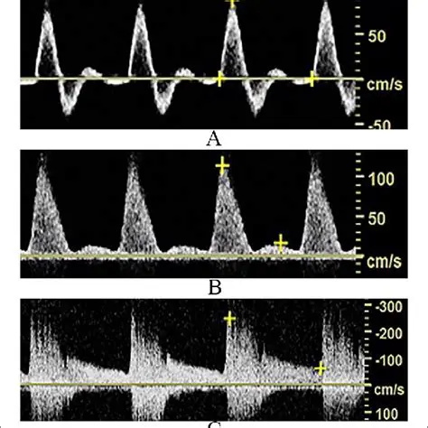 Spectral Doppler Waveform Patterns in PAD with Occlusion