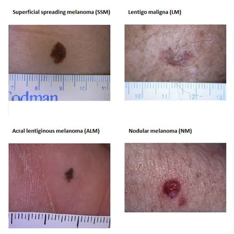 Superficial spreading melanoma