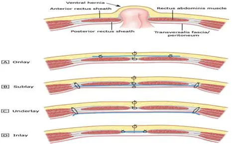 Support for Fronts with Inlay