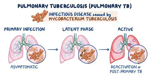 The Importance of Identifying Risk Factors for Pulmonary Tuberculosis