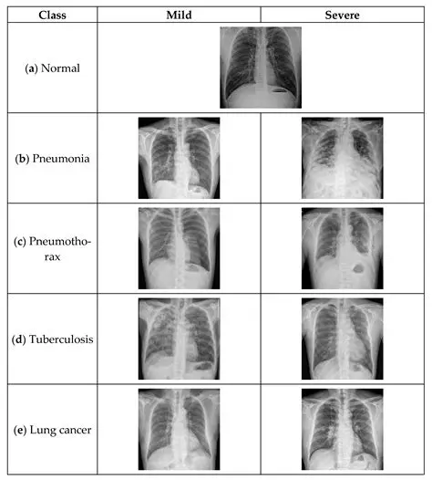 The Importance of Thoracic Photos in Diagnosing Pulmonary TB