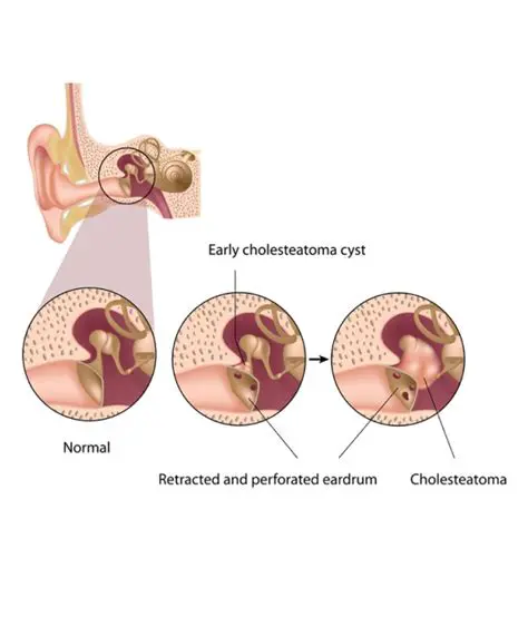 The Importance of Understanding Cholesteatoma