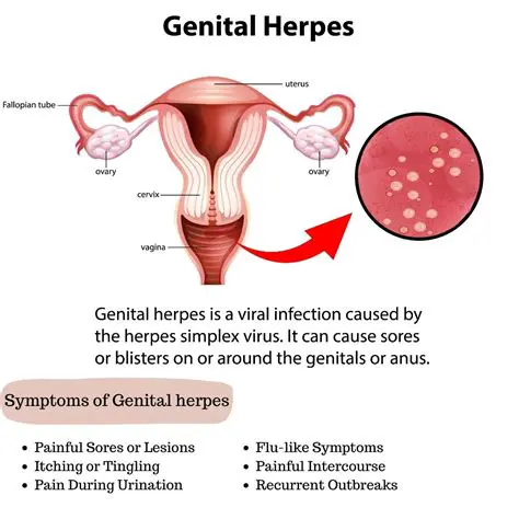 The Importance of Understanding Genital Herpes