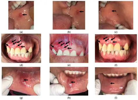 The Problem of Recurrent Aphthous Stomatitis Minor