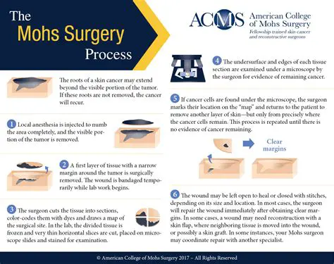 The Technique of Mohs Surgery