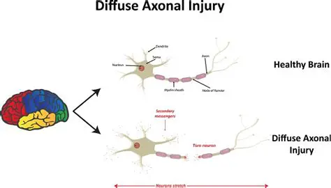 Understanding Diffuse Axonal Injury