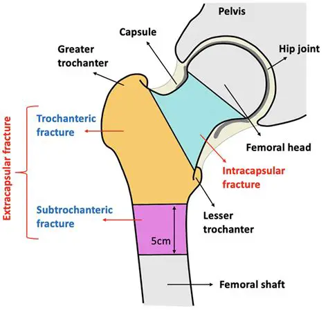 Understanding Intracapsular Hip Fractures